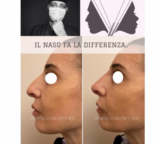 Rinoplastica Dott. Domenico Valente